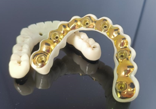 CAD/CAM titán implantátum rúd+cirkónia híd