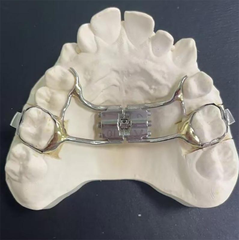 Mi az a gyors maxillary expander (RME)?