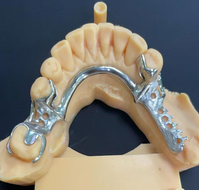 A Cobalt-Chromium Framework (Co Cr Framework) előnyei