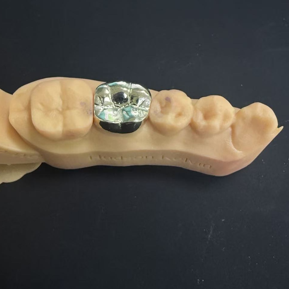 Aranykoronák: a nemesfém választás az egész életen át tartó fogpótláshoz