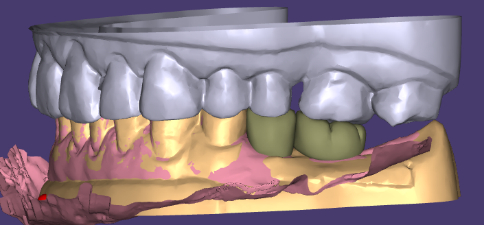 A WM Dental Lab esztétikai gyantázása és ideiglenes helyreállításai egyhangú vásárlói elismerést nyernek