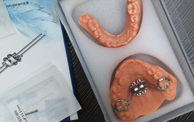 Ismerje meg az MSE csontváz bővítését a WM Dental Lab segítségével