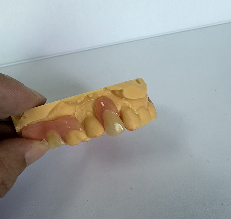 Valplast Partials a WM Dental Labban