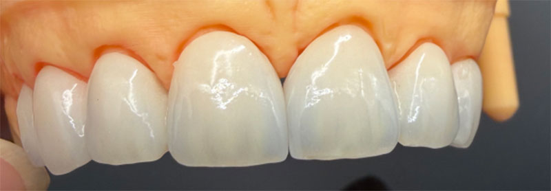 healthy tooth anatomy and dental shade comparison