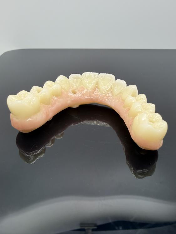 dental crown restoration example