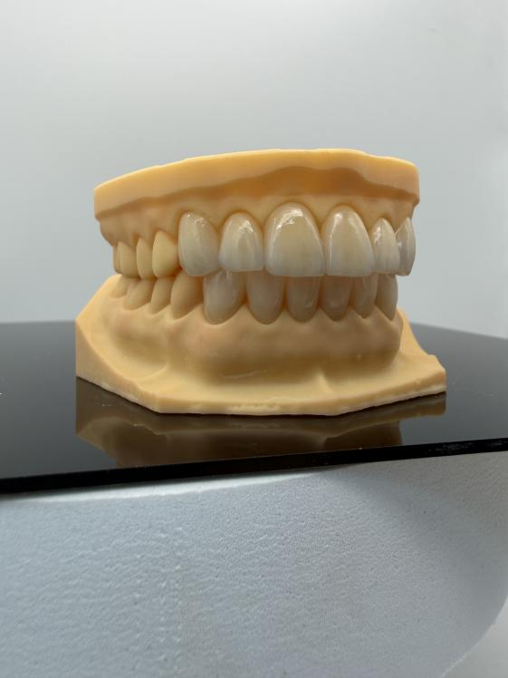 bridge and crown material comparison