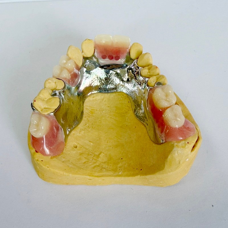 Kivehető helyreállítási részleges keret